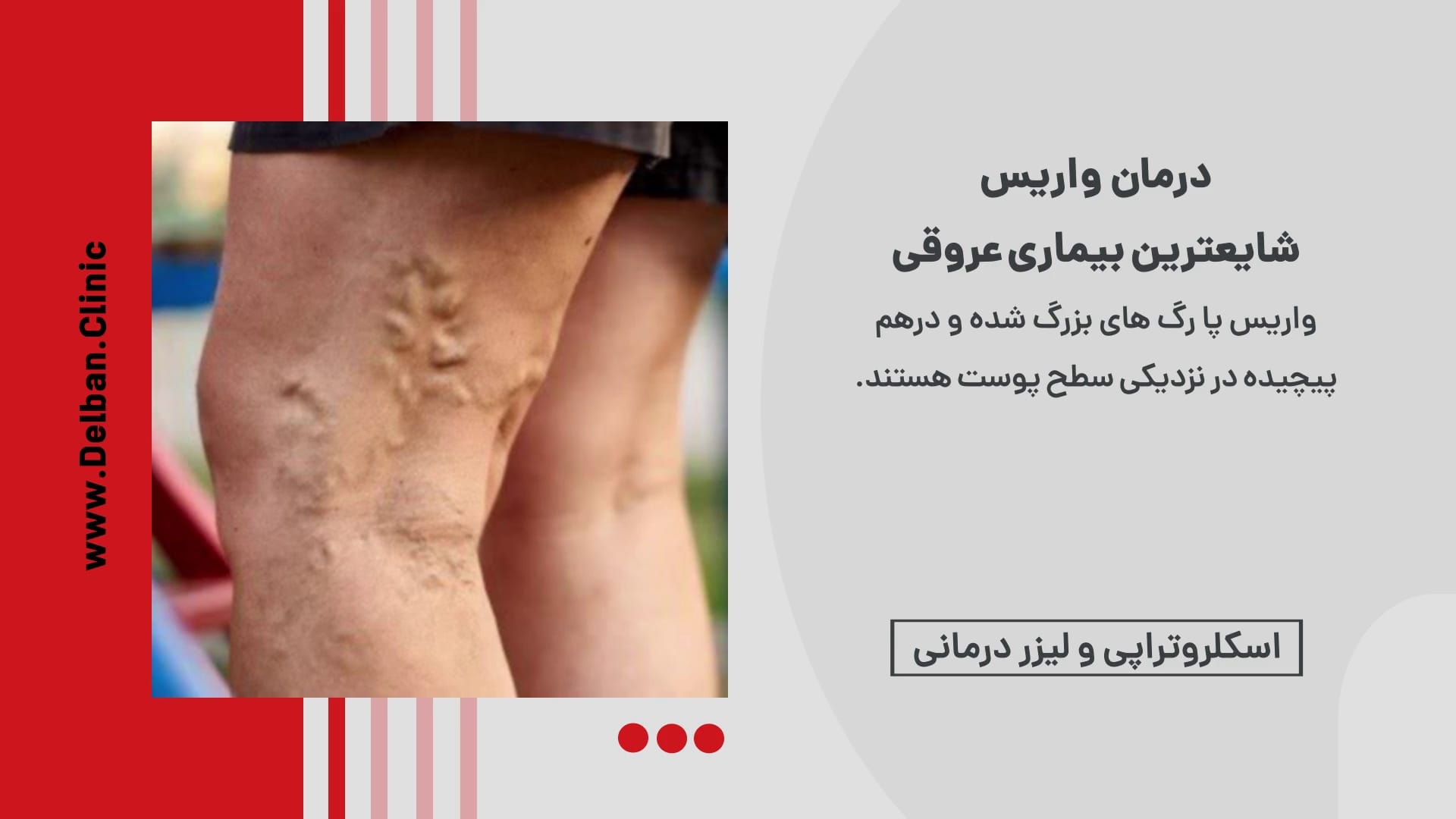 درمان واریس پا با لیزر