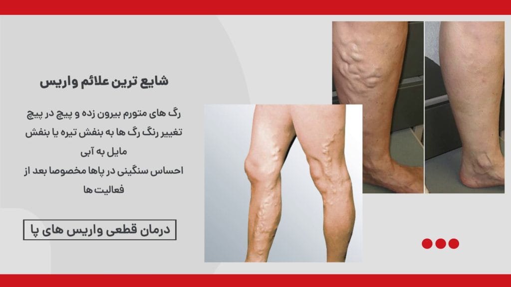 درمان واریس