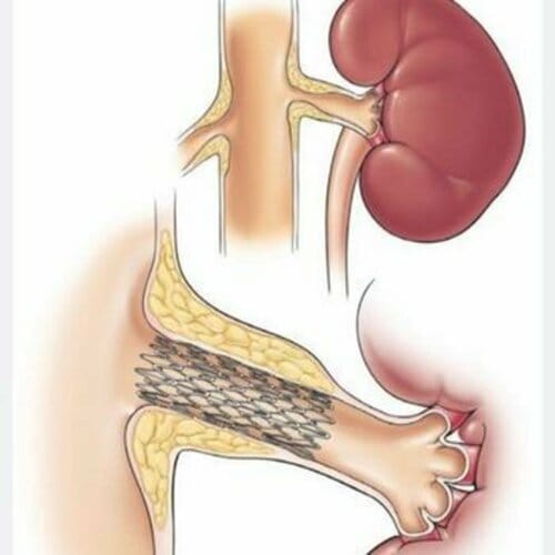 آنژیوپلاستی شریان کلیه