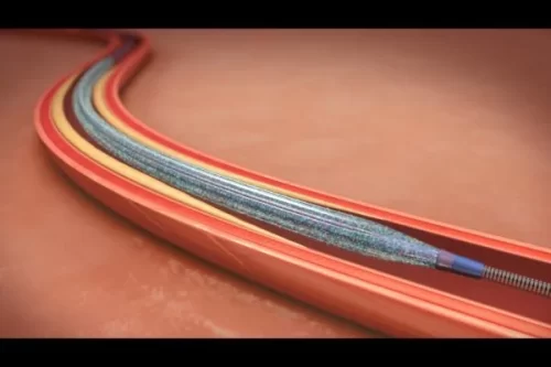 اسکورینگ بالون در آنژیوپلاستی عروق کرونر