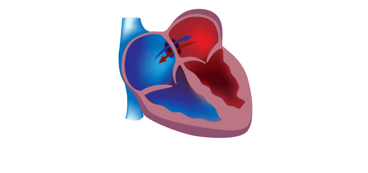 بستن PFO با اینترونشن