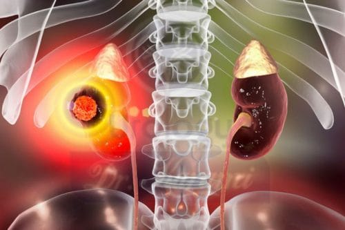 آرتریوگرافی (آنژیوگرافی کلیه)