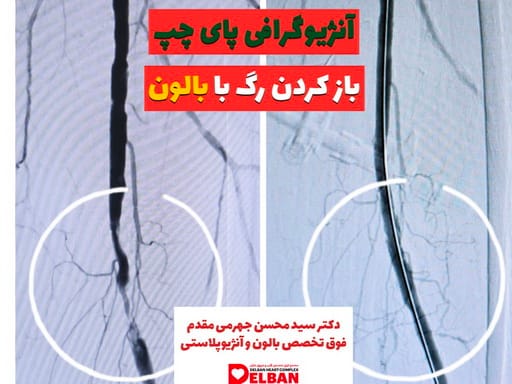 آنژیوگرافی عروق پا و فنر گذاشتن (استنت گذاری)