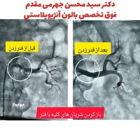 آنژیوپلاستی شریان کلیه
