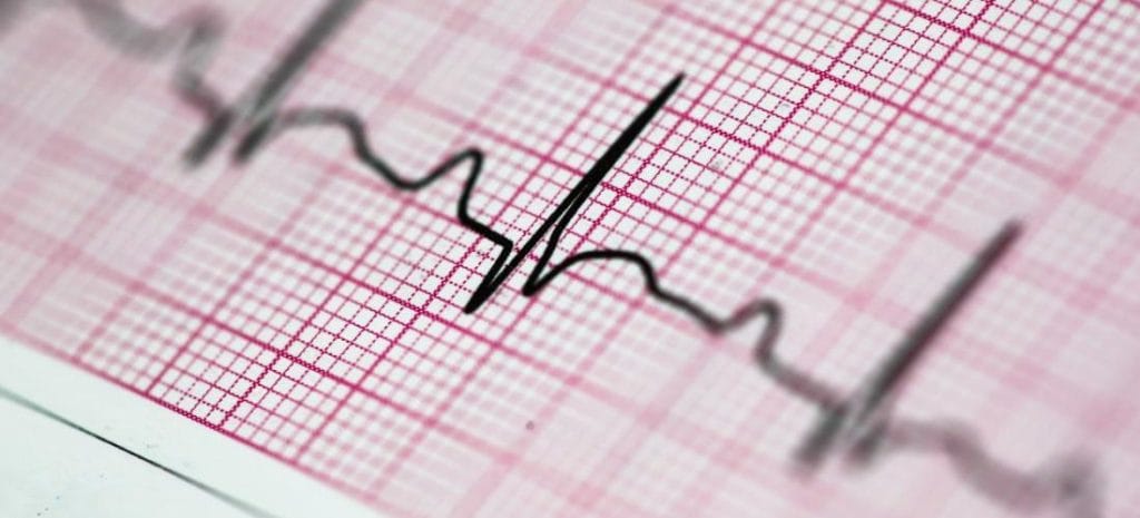 برادی آریتمی های قلبی