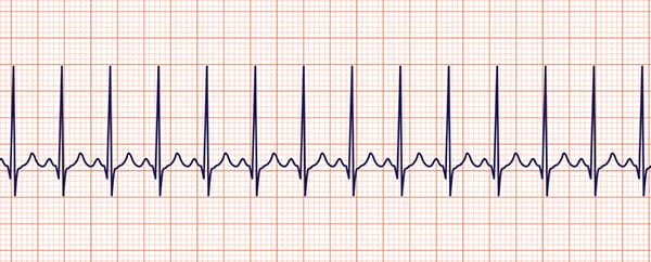 تاکی آریتمی های قلبی