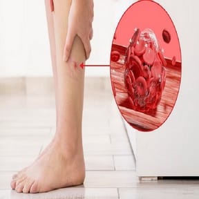 لخته خون در پا