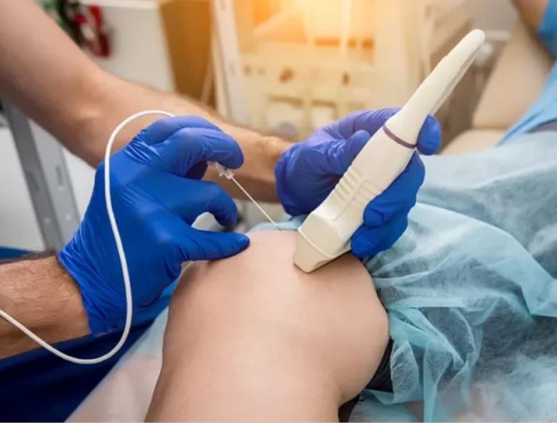 مراقبت پس از ابلیشن واریس